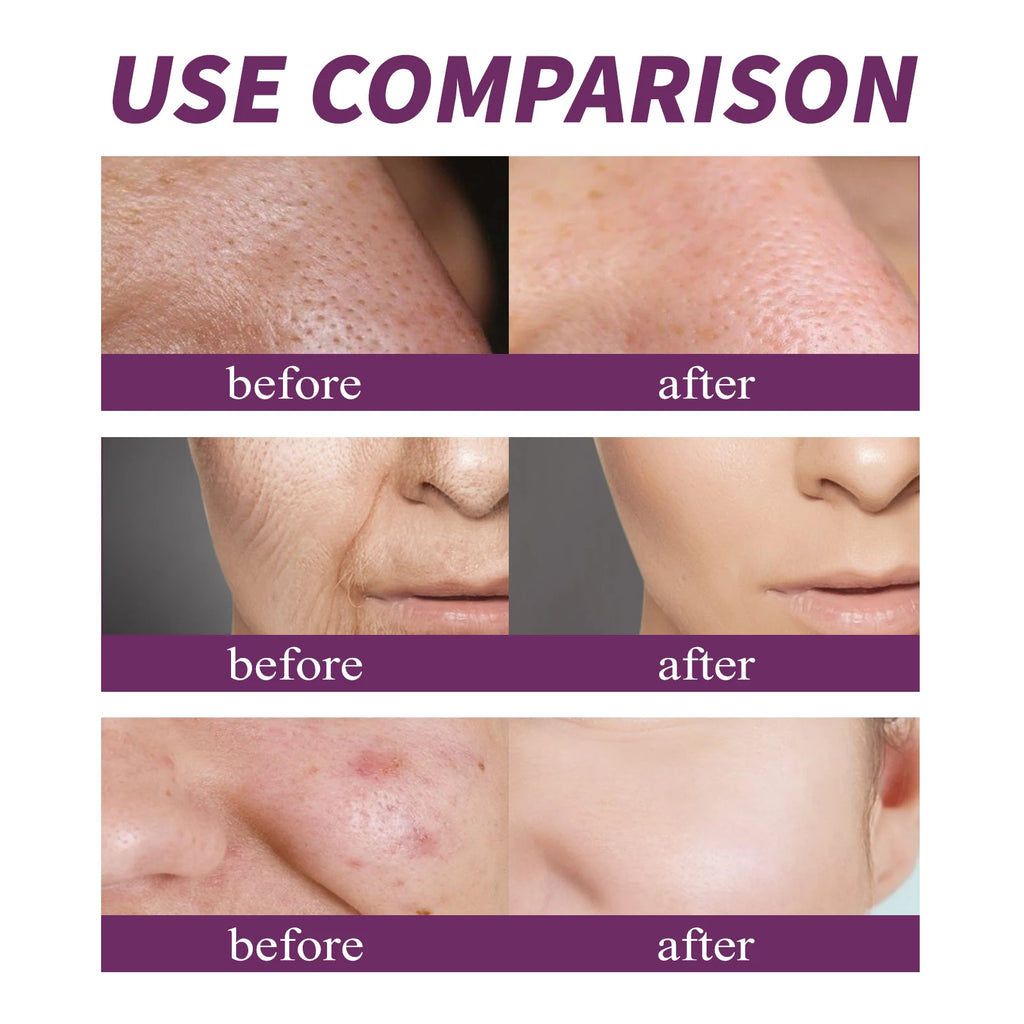 20% Niacinamide B3 Concentrated Anti-Aging For Discoloration And Minimizing Large Pores Fragrance Free And Paraben Free 20ml